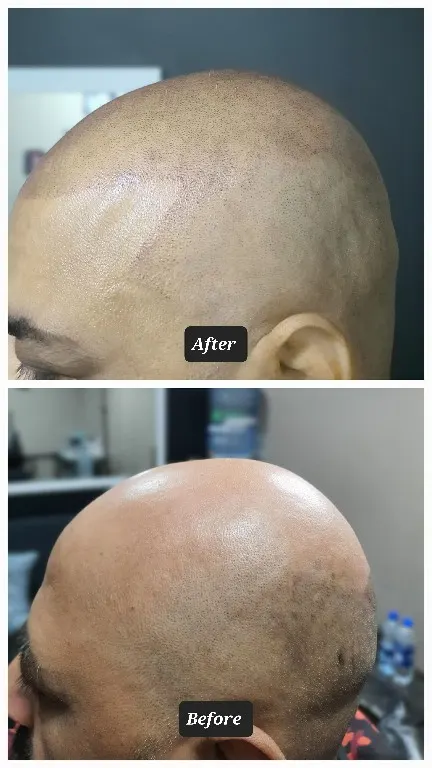 Scalp micropigmentation work