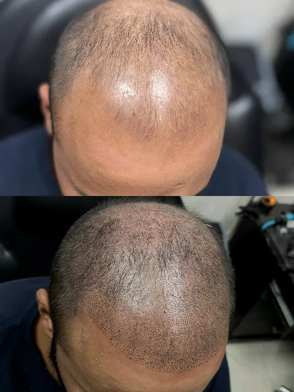 Scalp Micropigmentation