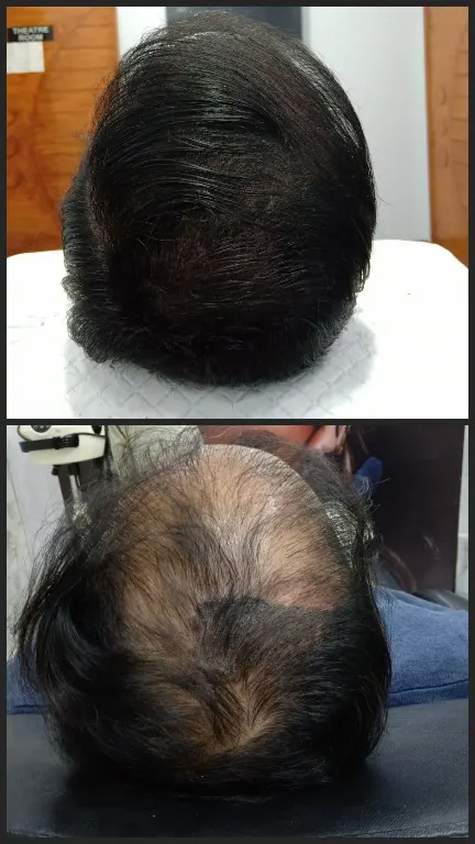 Scalp micropigmentation by Syinger Tattoos