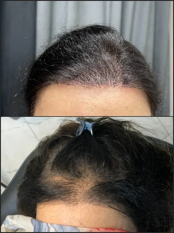 Scalp micropigmentation by Syinger Tattoos