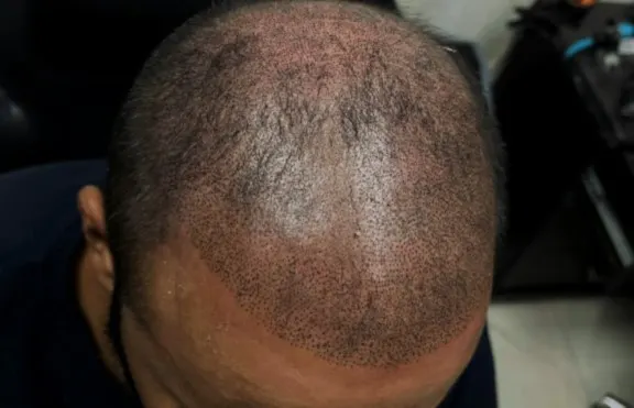 Scalp micropigmentation by Syinger Tattoos