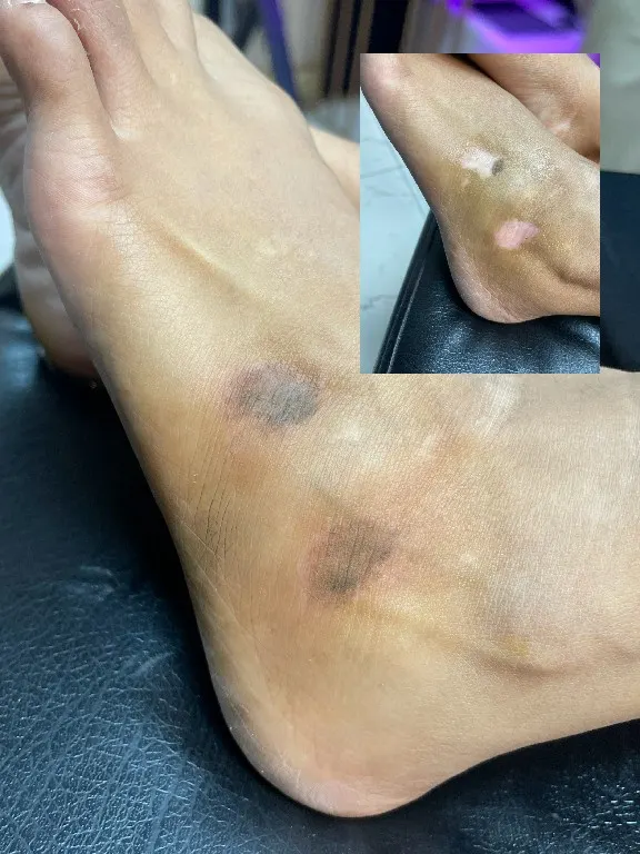 Vitiligo treatment work