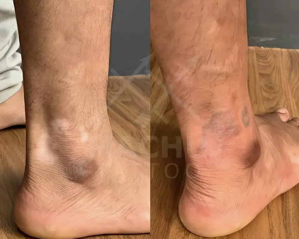 Vitiligo treatment by Syinger Tattoos