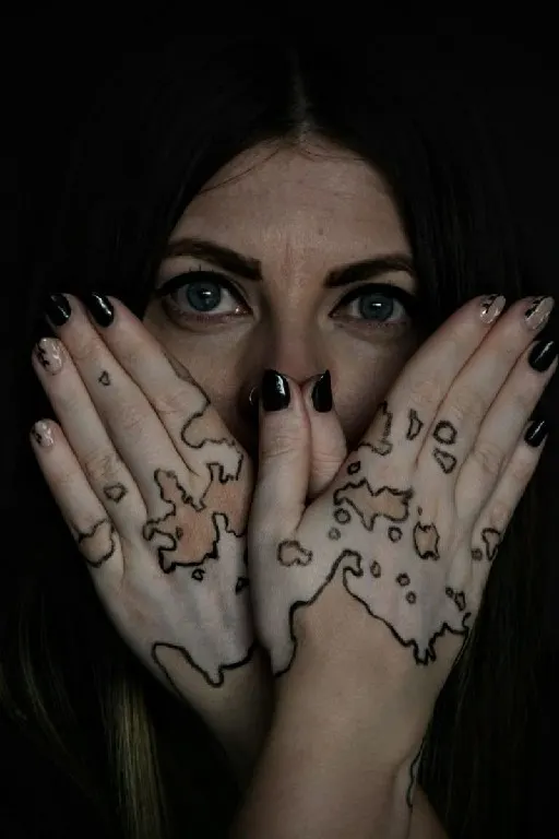 Vitiligo treatment by Syinger Tattoos