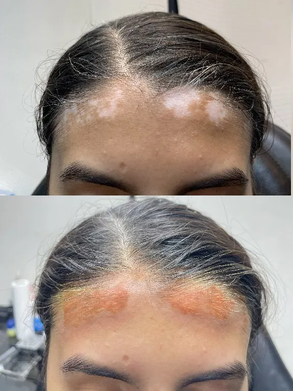 Vitiligo treatment by Syinger Tattoos