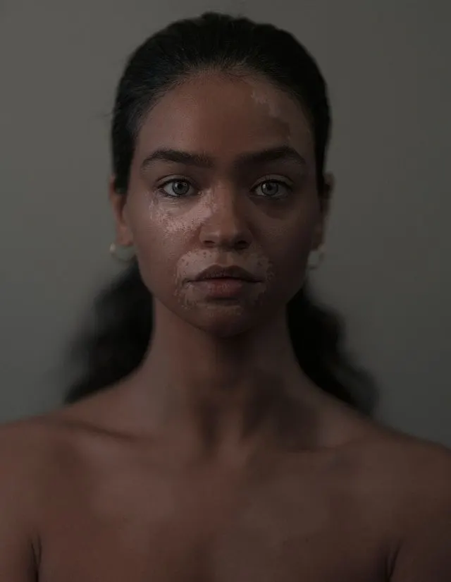 Vitiligo Treatment